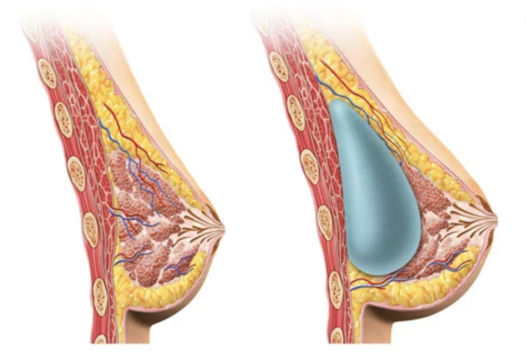 Potential Risks of Breast Augmentation