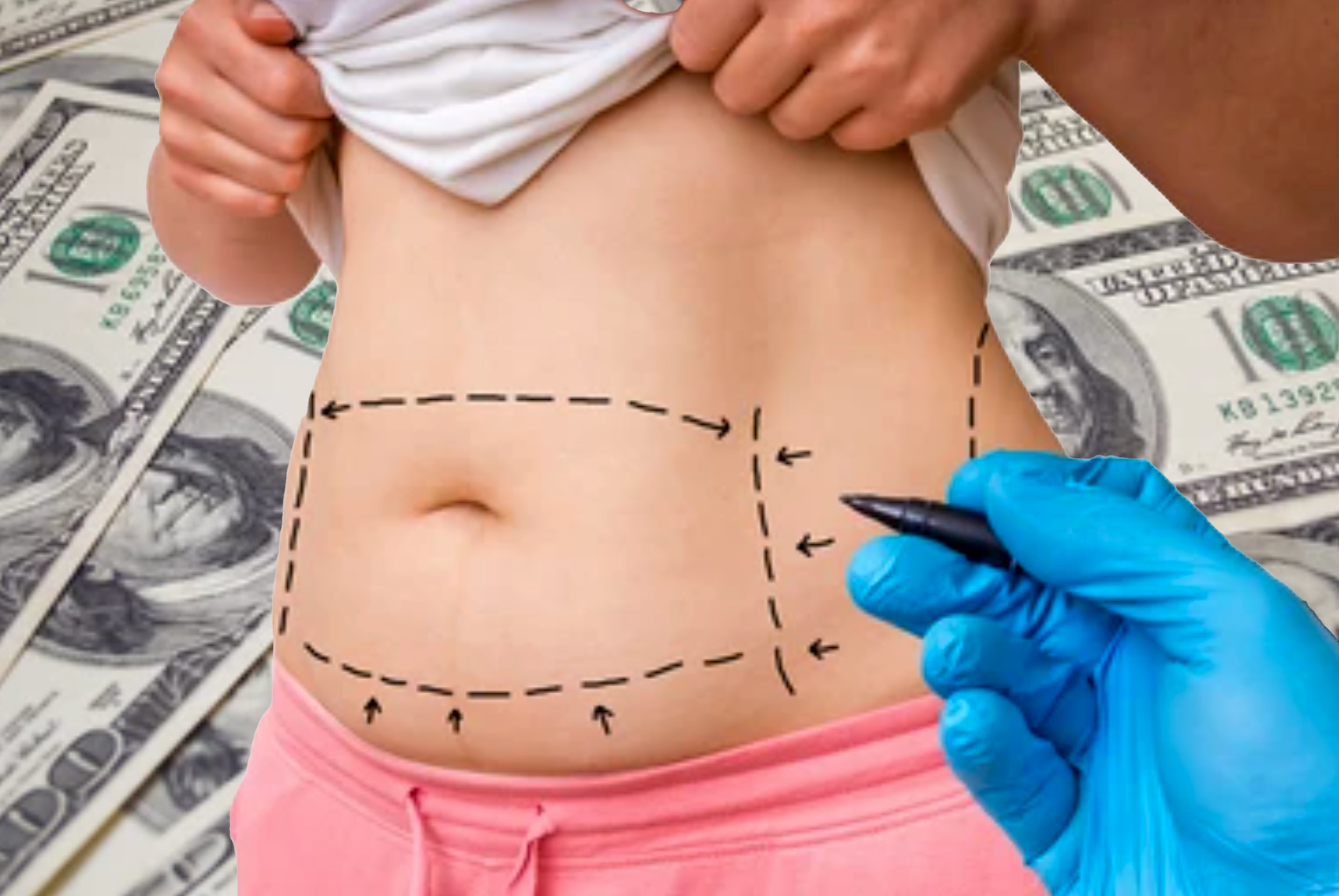 Tummy Tuck Cost In Miami